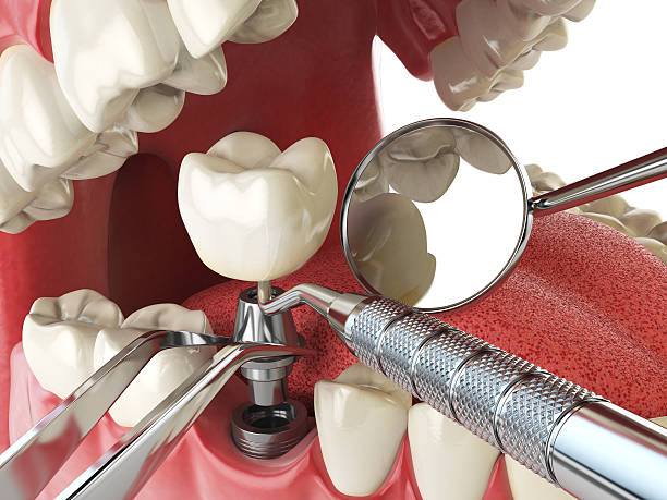 Best Emergency Root Canal Treatment in Lake Of The Woods, VA